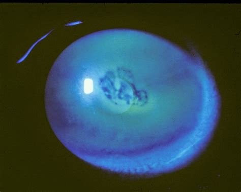 The Patient's Guide to Recurrent Corneal Erosion | Corneal, Medical photography, Eye health