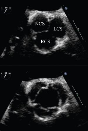 Aortic Valve Echo