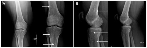 Bone Lesions Tuberous Sclerosis