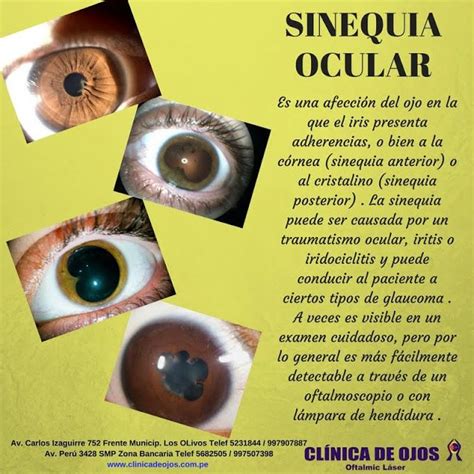 Clínica de Ojos Oftalmic Láser: SINEQUIA OCULAR | Enfermedades del ojo, Anatomía del ojo, Optica ...