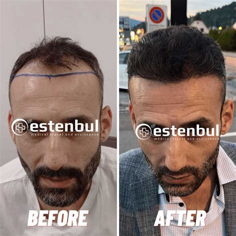 Saç Ekimi Öncesi Sonrası | Estenbul Health