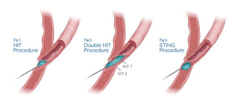 See how pediatric urologists administer Deflux - Deflux