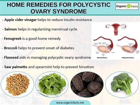 Home Remedies for Polycystic Ovary Syndrome