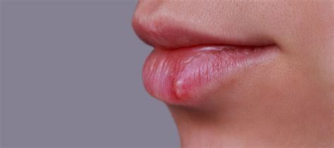 Herpes labial: Causas, prevención y tratamiento