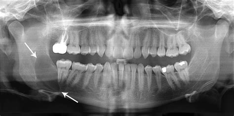 File:Classic keratocystic odontogenic tumour.jpg - Wikimedia Commons