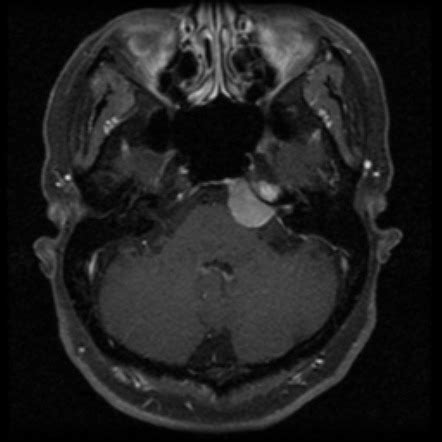 Petrous apex lesions (differential) | Radiology Reference Article | Radiopaedia.org