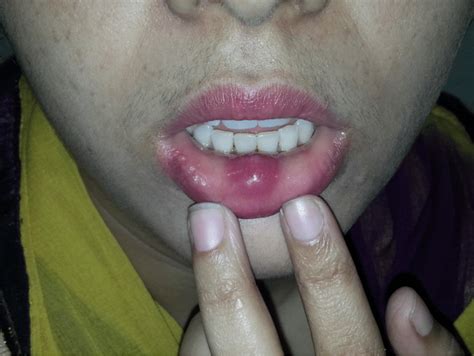 Photograph of cystic swelling lower lip diagnosed as tuberculous lesion ...