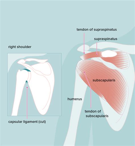 Dealing With Acromion Pain With The Best Exercises For Relief | Physiotherapists in Toronto ...