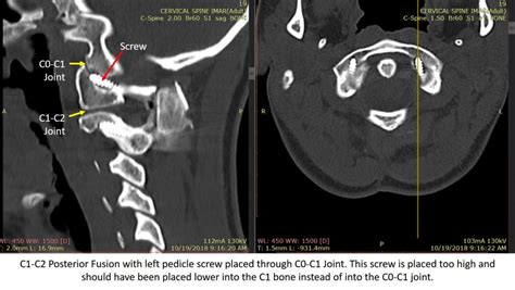 C1-C2 Fusion - Complications Are Common | Centeno-Schultz