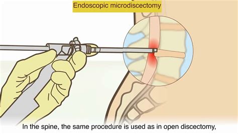 A herniated disc - What is it and what surgical treatments are available? - YouTube