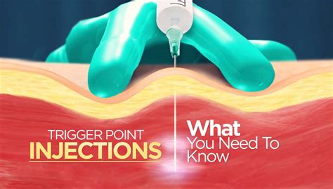 Trigger Point Injections: What You Need to Know - THE ORTHOHEALING CENTER