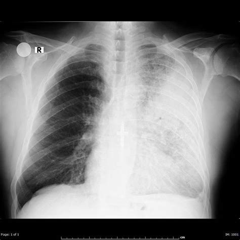 Pneumonia Radiograph