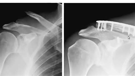 Distal Clavicle Fracture