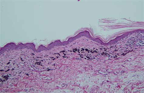 Consultations in Dermatoscopy: Dysplastic Junctional lentiginous nevus