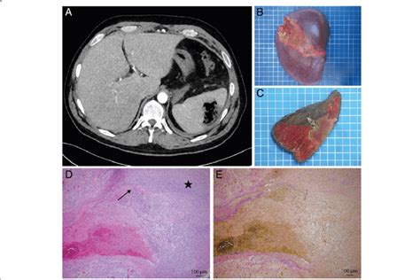 a Computed tomography axial picture showing the necrotic splenic... | Download Scientific Diagram