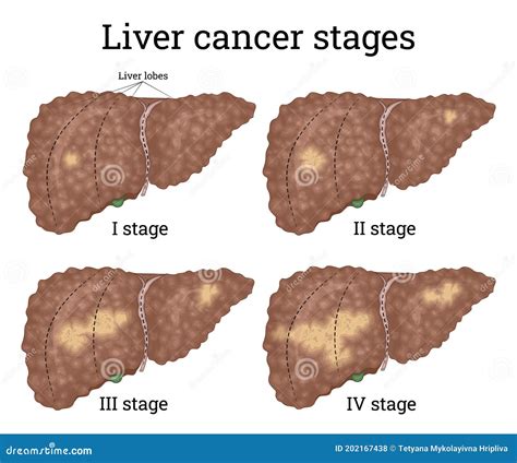 Liver Cancer Types And Stages