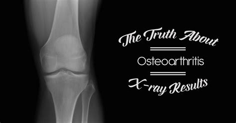 The Truth About Osteoarthritis X-ray results