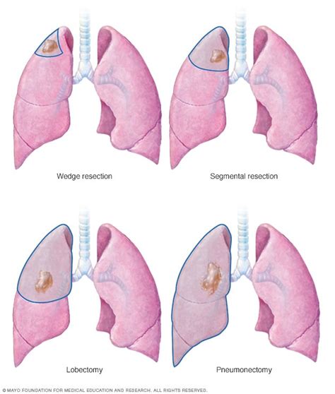 Lung cancer - Diagnosis and treatment (2022)