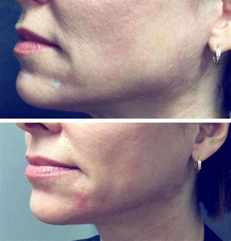 Thermage Before And After Photos Face (2) | Thermage, Facelift, Face