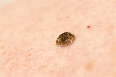 Seborrheic Keratosis Also Known As Seborrheic Verruca Or A Senile Wart ...