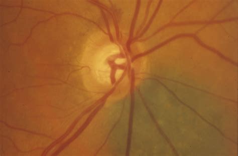 Optic disc hemorrhage: Don’t miss the signal - EyeWorld