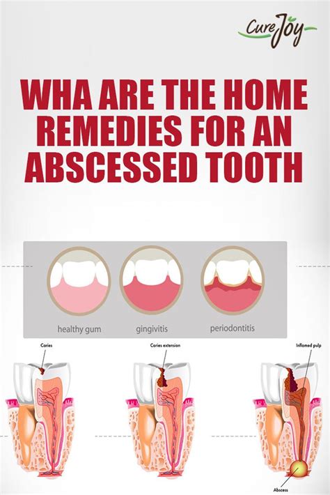 What Are The Home Remedies For An Abscessed Tooth? | Home health remedies, Remedies, Natural cures