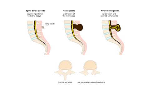 Neural Tube Defects:Facts, types, causes, diagnosis, & prevention | FactDr