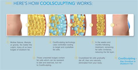 CoolSculpting Cost 2020: Price, Reviews, Side Effects, Before And After ...