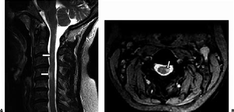 Cervical Spine Mri Ms