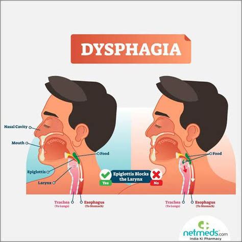 Treatment of dysphagia - MEDizzy