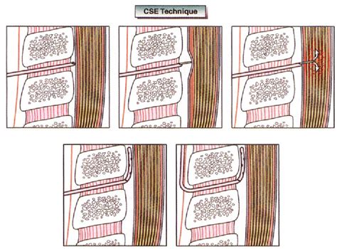 Figure 2 from Combined Spinal-Epidural Analgesia in Obstetrics | Semantic Scholar