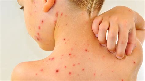 Chickenpox outbreak at North Carolina school with high anti-vaccination ...