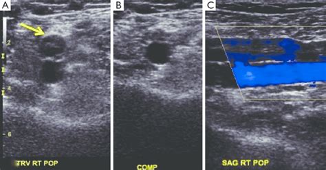 Acute Dvt Ultrasound