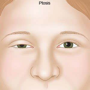 Ptosis - What You Need to Know