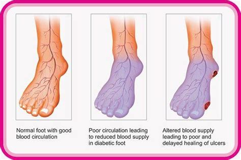 Blood Clot On Heel Of Foot Top Sellers | emergencydentistry.com