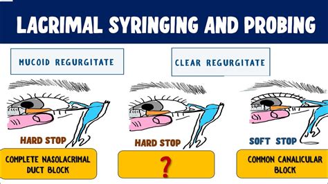 Lacrimal Syringing and Probing : Technique and Interpretation of results - YouTube