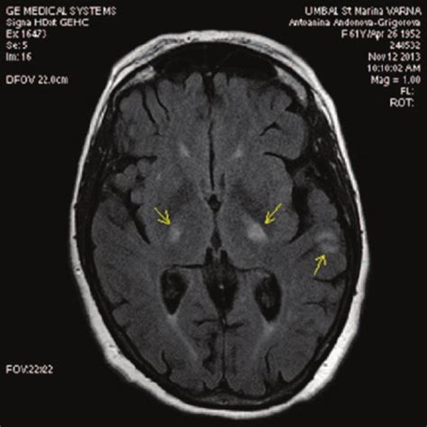 Periventricular Lesions