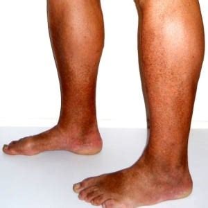 Operation better than exercise for poor leg circulation | Health24