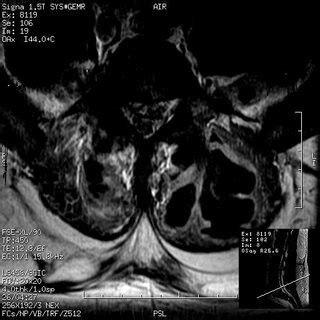 Another view of Lumbar spine MRI showing paraspinal abscess. | Download Scientific Diagram