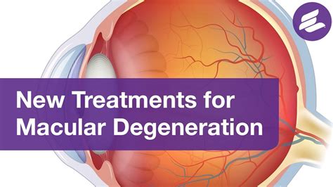 What Is Age Related Macular Degeneration Treatment at Thomas Schultz blog