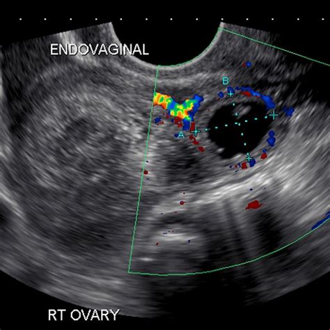 Ectopic Pregnancy – Core EM