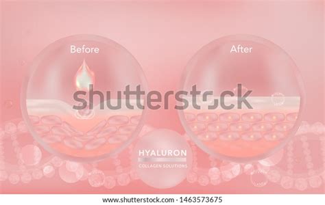 Hyaluronic Acid Before After Skin Solutions Stock Vector (Royalty Free) 1463573675 | Shutterstock