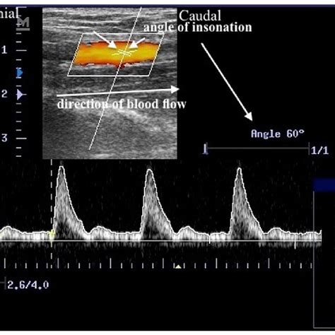 PWD Ultrasound of the brachial artery after brachial plexus block. PS:... | Download Scientific ...