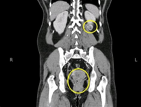 Cureus | Incidental Renal Cell Carcinoma in Pelvic Malignancies