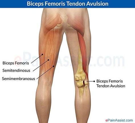 Leg Tendon Behind Knee : Pain Back Knee Tedinitis Sioux City - What to ...