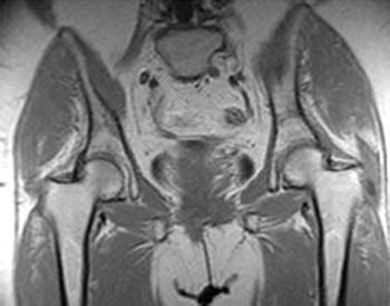 Gluteus Minimus Tear & Trochanteric Bursitis - Radsource