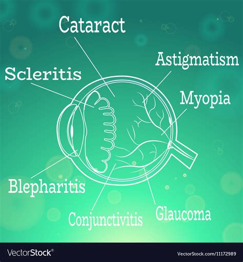 Human eye diseases Royalty Free Vector Image - VectorStock