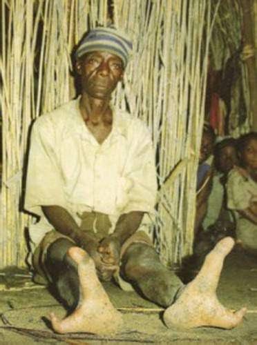 Meet A Tribe Whose People Have Just Two Toes, Zimbabwe’s Bantwana Tribe ...