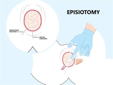 Episiotomy Wound Online Cheapest | alumni.uod.ac