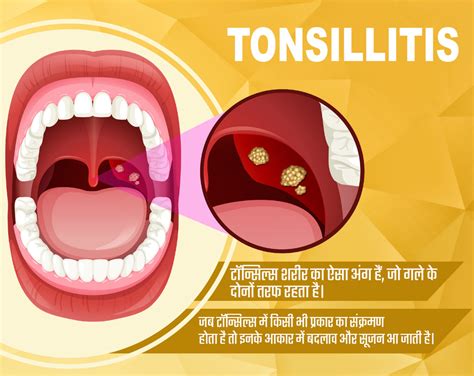 Tonsils Surgery - Kaushik ENT Hospital